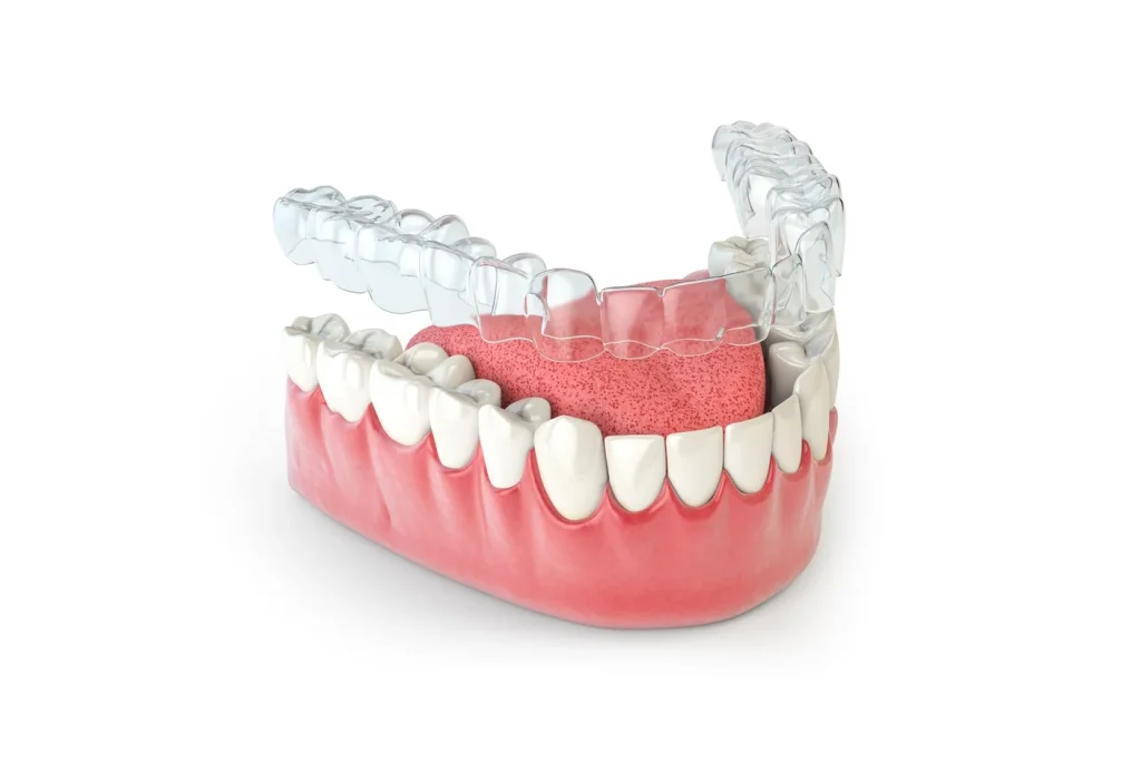 Dental Braces & Invisalign Aligner