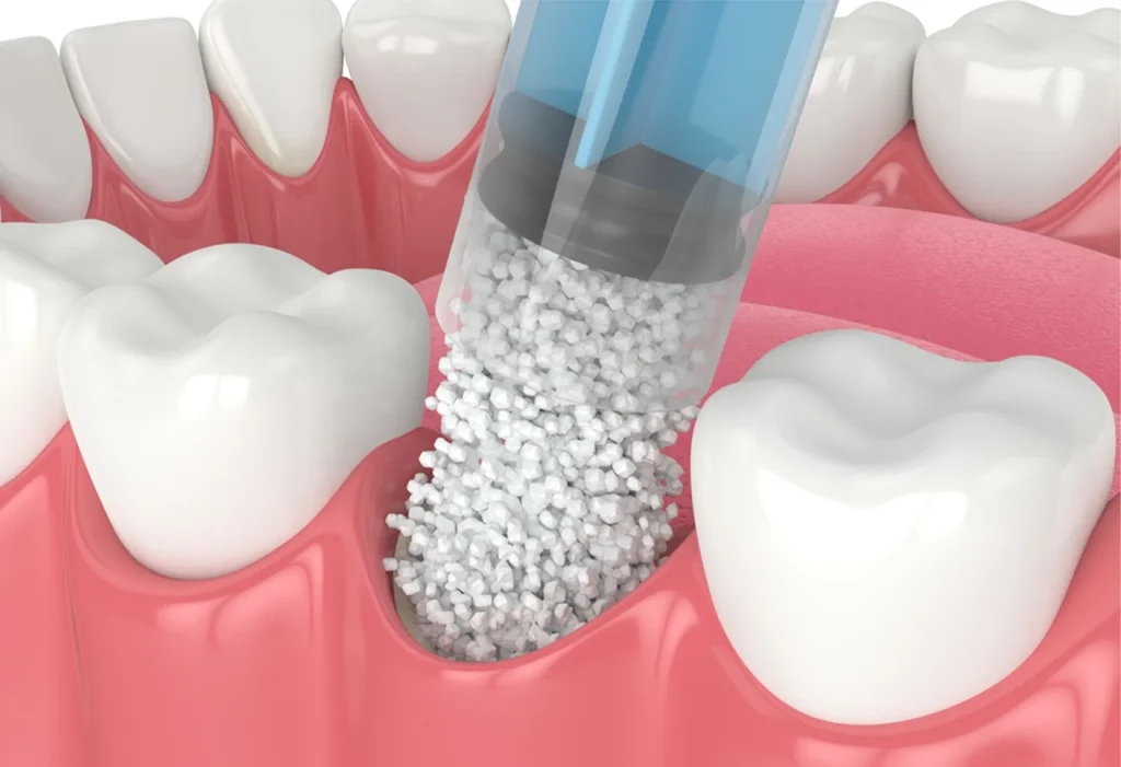 Bone Grafting