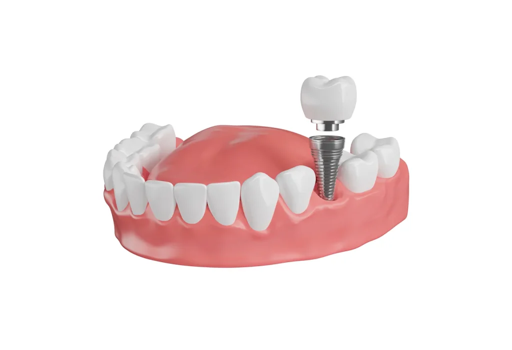 Dental Implant