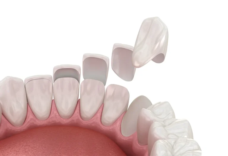 Dental Veneers