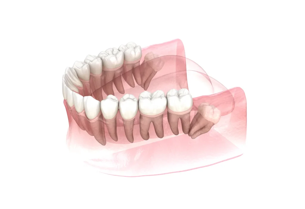 Wisdom Tooth Removal